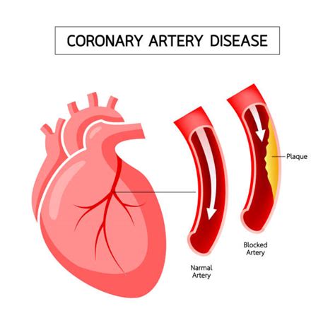 Coronary Artery Disease Illustrations Royalty Free Vector Graphics