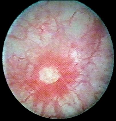 Category Interstitial Cystitis Wikimedia Commons