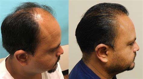 2900 Hair Graft 4 Month Follow Up Hair Transplant Case Study