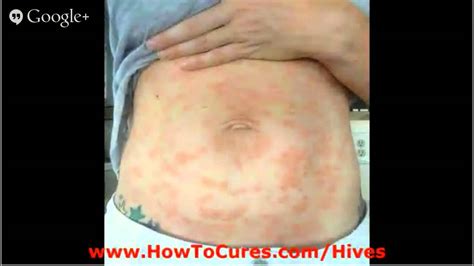 Chronic Hives Treatment Remedies For Soothing Aquagenic Urticaria