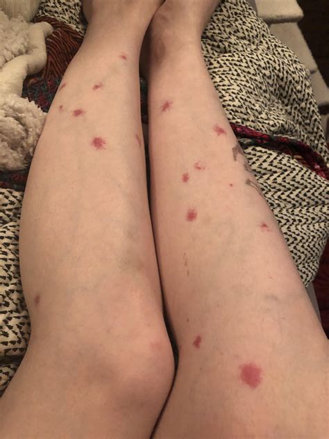 Please Help Me Identify This Rash Dermatology