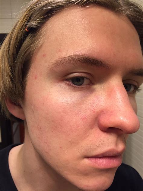 Skin Concerns Very Often My Right Cheek Feels Like Its Burning A