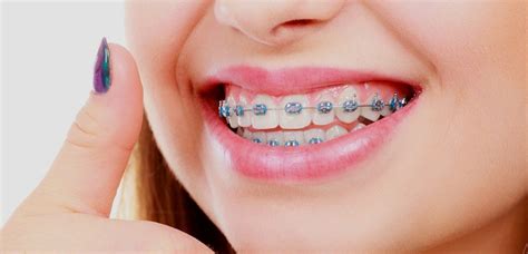 Best Orthodontist In Pune Orthodontist Near Me In Pimpri Chinchwad Affordable Braces Treatment