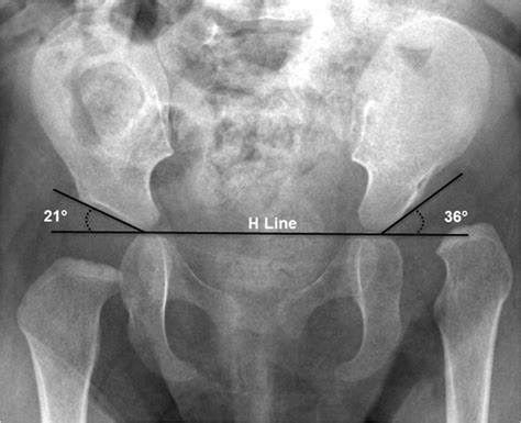 Acetabular Index On Radiography Anteroposterior Radiography In An
