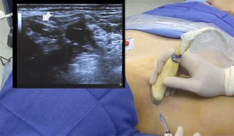 Ultrasound Guided Interscalene Brachial Plexus Block Video Nysora The