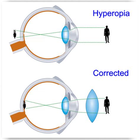 Hyperopia Eye Exams Optometrists Oxford And Henderson Nc