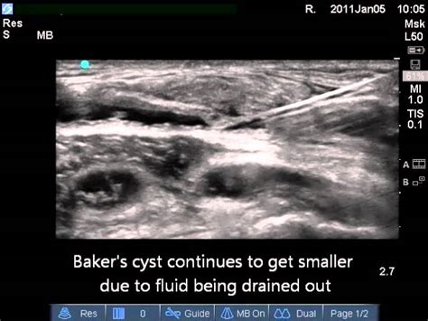 Ultrasound Guidance On Draining And Closing Bakers Cyst Regenexx Videos