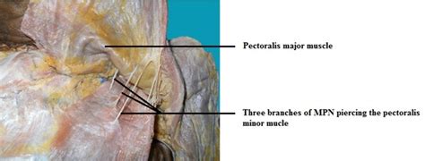 Anatomical Study Of Pectoral Nerves And Its Implications In Surgery