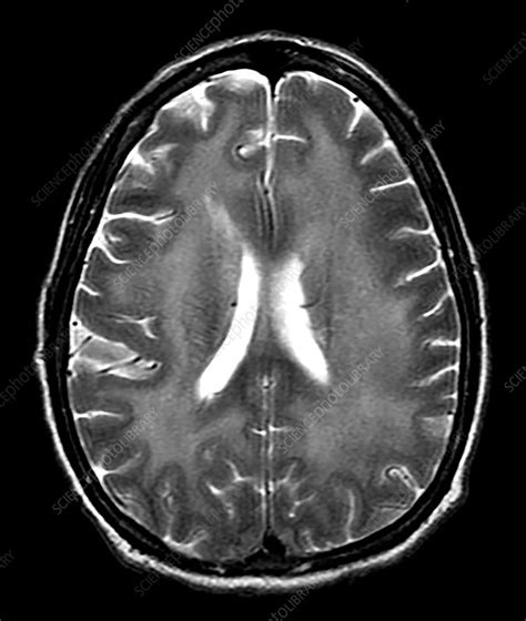 Hiv Encephalitis On Mri Stock Image C0435615 Science Photo Library