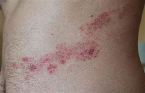 Herpes Zoster Infection The Bmj