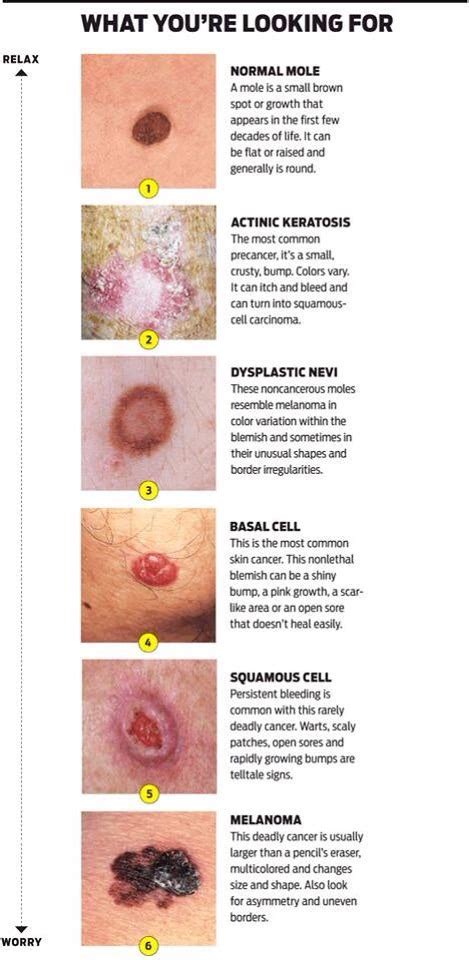 🔆different Types Of Skin Cancer What To Look For👍 Trusper