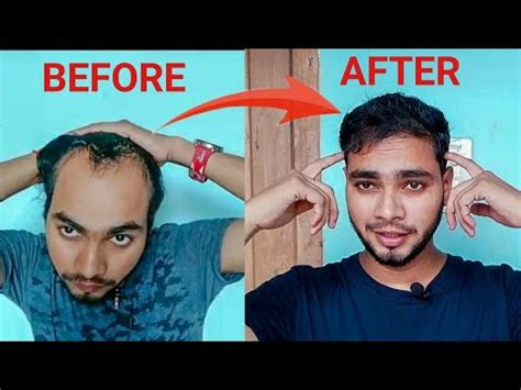 Month Result Of My Hair Transplant Ganesh Thakur YouTube