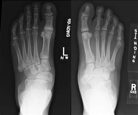 Figure 2 From Long Term Results Of Tibialis Anterior Tendon Transfer For Relapsed Idiopathic