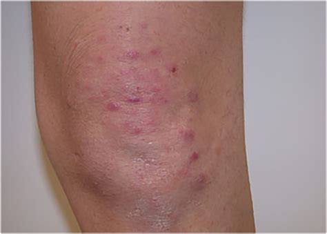 T Cell Lymphoma Skin Rash Cutaneous T Cell Lymphoma The Rashes Are