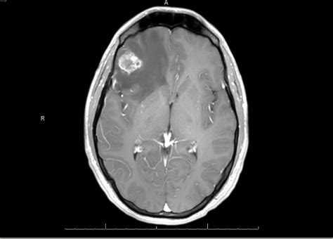 Cureus Brain Metastases As Presenting Feature In Burned Out
