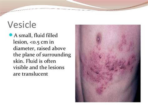What Are The 3 Types Of Lesions Pdfshare