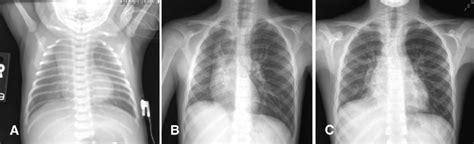 Serial Chest Radiographs In A Patient With Late Diagnosis Of Ductal