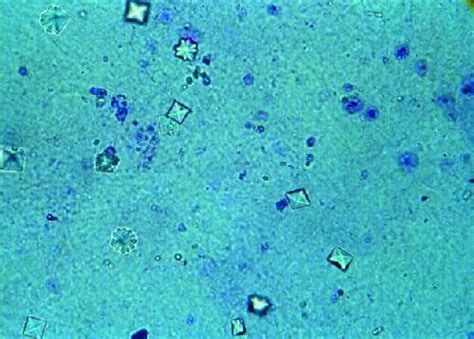 Filecalcium Oxalate Crystals In Urine Wikipedia