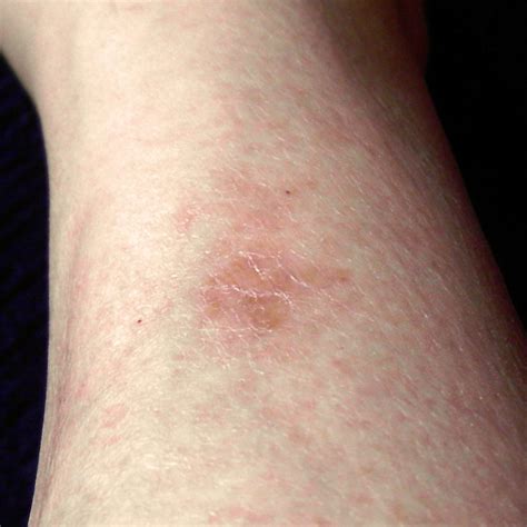 Lesions tend to be red. A spider bite photographed for two months | Probaway ...
