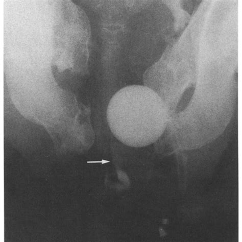Retrograde Urethrogram Shows Extravasation At Bulbous Urethra