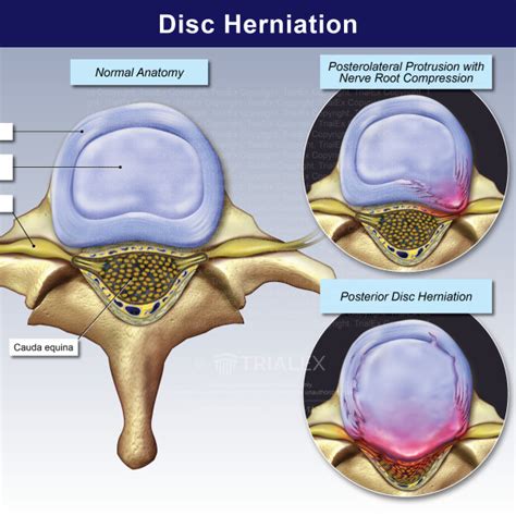 Disc Herniation Trialexhibits Inc
