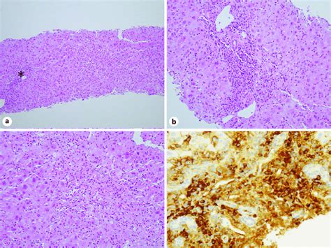 Histopathological Findings Of The Liver A Massive Centrilobular