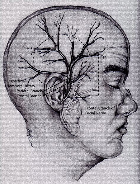 Temporal Arteritis Aka Giant Cell Arteritis And Temporal Artery Biopsy