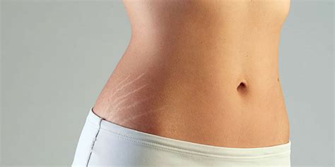 How To Get Rid Of Stretch Marks Ping Blog