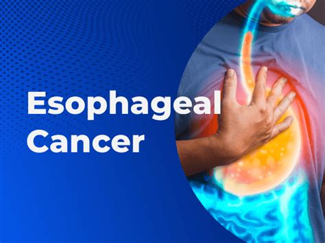 Esophageal Cancer Causes Types Treatment Symptoms And Signs