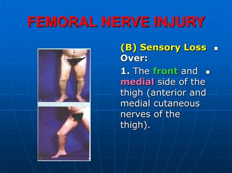 Ppt Femoral Nerve Injury Powerpoint Presentation Id