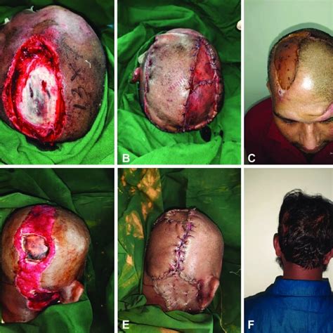 A Post Electric Burn Wound Over Scalp With Exposed Skull Bone B