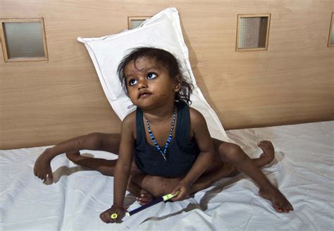 Body Bizarre Episode 1picture Shows Lakshmi Tatma From India Was Born With A Parasitic Twin