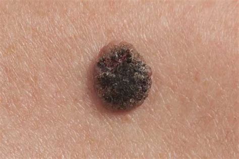 Types Of Skin Cancer Mole Patrol Bulk Bill Skin Check Perth