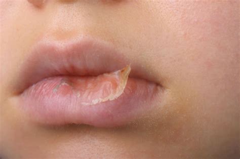 Eczema On Lips Causes And Cures