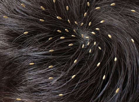 Head Lice Causes Symptoms And Treatments