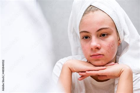 Acne A Sad Teenage Girl Problematic Skin In Adolescents Stock Photo
