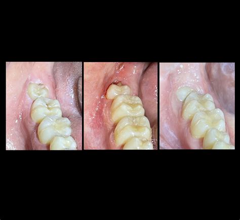 Wisdom Teeth Infection Before Removal
