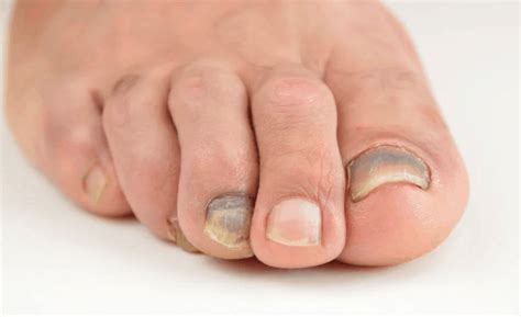 Suffering With Dark Spots Under Your Toenails Treatments