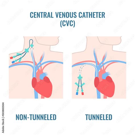 Tunneled And Non Tunneled Central Venous Catheters Placed In The
