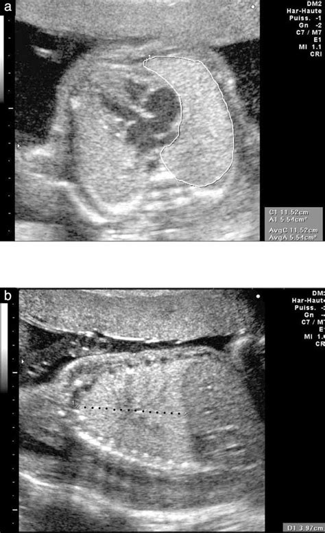 Fetal Lung Volumetry Using Two‐ And Three‐dimensional Ultrasound Moeglin 2005 Ultrasound