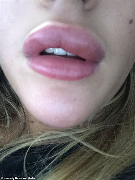 Woman Claims That Filler Treatment Left Her Lips Swollen I Know All News