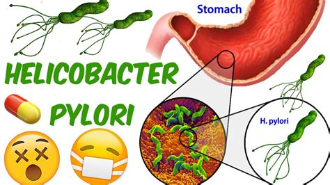 h pylori diet, le meilleur porte . vente de maintenant