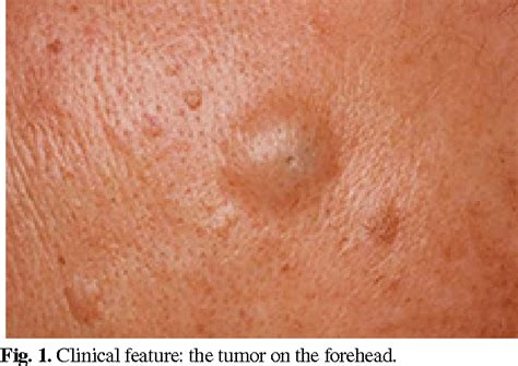 Figure 1 From Epidermal Cyst With Ossification A Patient Report