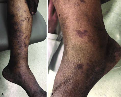 A Retiform Purpura On The Left Side Of The Lower Extremity B