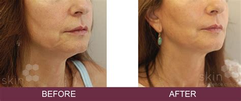 Silhouette Soft Thread Lifts Non Surgical Face Lift Skin Excellence