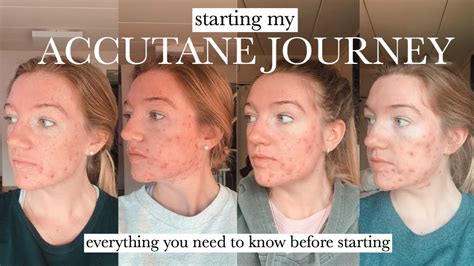 ACCUTANE MONTH Cystic Hormonal Acne What To Expect On Accutane Side Effects Confidence
