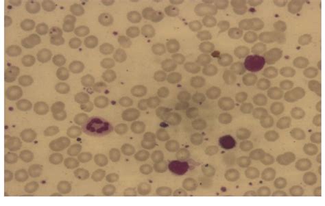 Peripheral Blood Smear Showing Normocytic Normochromic Anemia With No