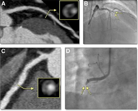 Napkin Ring Sign On Coronary Ct Angiography For The Prediction Of Acute