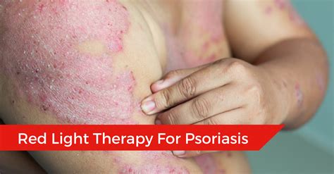 Red Light Therapy For Psoriasis Does Led Light Therapy Work