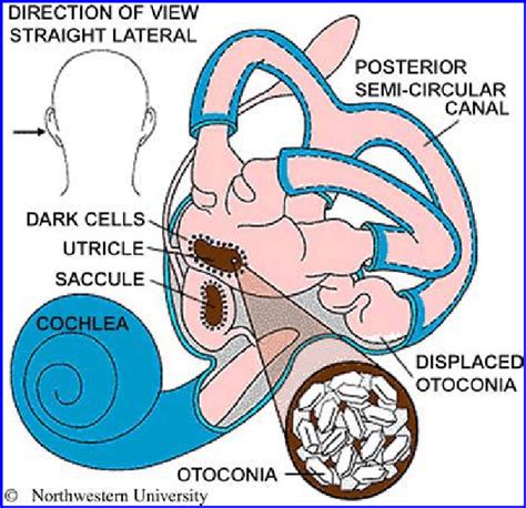 Anatomy Of The Left Inner Ear Showing Displaced Otoconia From The